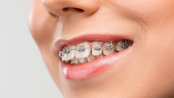 Braces_For_Auction 