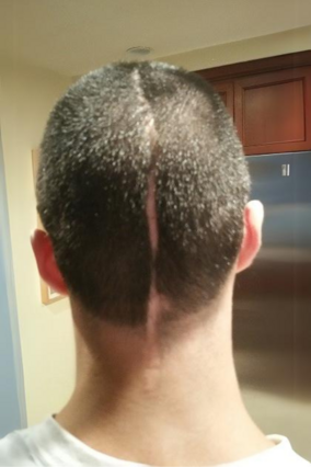 Wish Alum Michael's head with scar